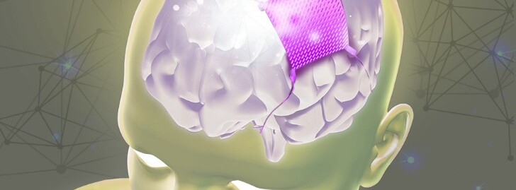 Minimal Invasive Subdural Electrocorticographic Brain-Computer Interface